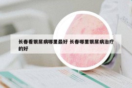 长春看银屑病哪里最好 长春哪里银屑病治疗的好