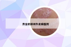 齐全的郑州牛皮癣医院