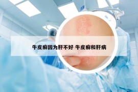 牛皮癣因为肝不好 牛皮癣和肝病