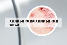 大胳膊和小腿长银屑病 大胳膊和小腿长银屑病怎么办
