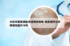 大庆对银屑病能申请慢性救助 银屑病可以办理慢性医疗卡吗