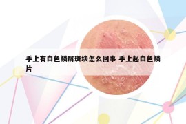 手上有白色鳞屑斑块怎么回事 手上起白色鳞片