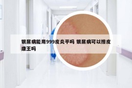 银屑病能用999皮炎平吗 银屑病可以擦皮康王吗