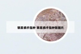 银屑病手指肿 银屑病手指肿胀图片