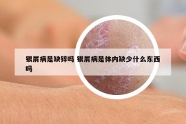 银屑病是缺锌吗 银屑病是体内缺少什么东西吗