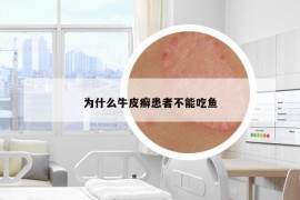 为什么牛皮癣患者不能吃鱼