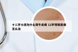 十二岁小孩为什么得牛皮癣 12岁得银屑病怎么治