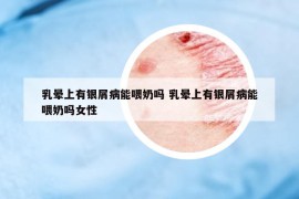 乳晕上有银屑病能喂奶吗 乳晕上有银屑病能喂奶吗女性