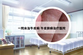 一院水治牛皮癣 牛皮肤癣治疗医院