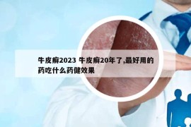 牛皮癣2023 牛皮癣20年了,最好用的药吃什么药健效果