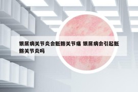 银屑病关节炎会骶髂关节痛 银屑病会引起骶髂关节炎吗