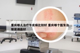 重庆哪儿治疗牛皮癣比较好 重庆哪个医生治银屑病最好