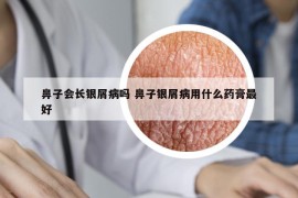 鼻子会长银屑病吗 鼻子银屑病用什么药膏最好