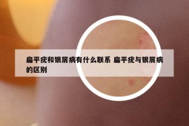 扁平疣和银屑病有什么联系 扁平疣与银屑病的区别