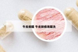 牛皮癣醋 牛皮肤癣用醋洗
