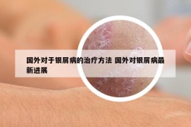国外对于银屑病的治疗方法 国外对银屑病最新进展