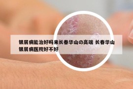 银屑病能治好吗来长春华山の高端 长春华山银屑病医院好不好