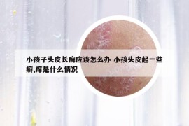 小孩子头皮长癣应该怎么办 小孩头皮起一些癣,痒是什么情况