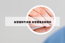 血管瘤和牛皮癣 血管瘤是皮肤癌吗