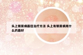 头上银屑病最佳治疗方法 头上有银屑病用什么药最好