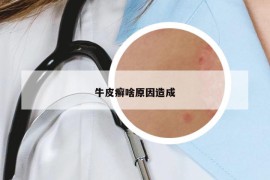 牛皮癣啥原因造成