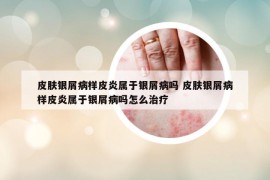 皮肤银屑病样皮炎属于银屑病吗 皮肤银屑病样皮炎属于银屑病吗怎么治疗