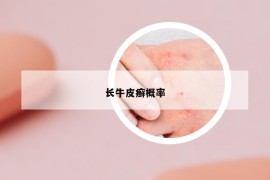 长牛皮癣概率
