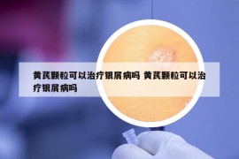 黄芪颗粒可以治疗银屑病吗 黄芪颗粒可以治疗银屑病吗