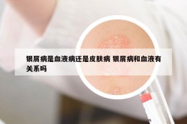 银屑病是血液病还是皮肤病 银屑病和血液有关系吗