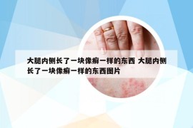 大腿内侧长了一块像癣一样的东西 大腿内侧长了一块像癣一样的东西图片