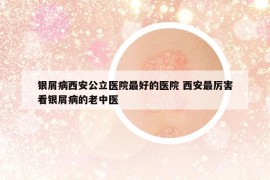 银屑病西安公立医院最好的医院 西安最厉害看银屑病的老中医