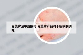 完美牌治牛皮癣吗 完美牌产品对于疾病的调理
