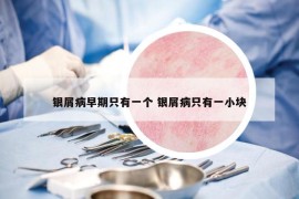 银屑病早期只有一个 银屑病只有一小块