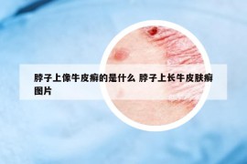 脖子上像牛皮癣的是什么 脖子上长牛皮肤癣图片