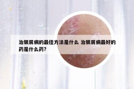 治银屑病的最佳方法是什么 治银屑病最好的药是什么药?