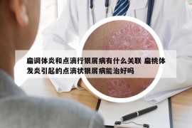 扁调体炎和点滴行银屑病有什么关联 扁桃体发炎引起的点滴状银屑病能治好吗