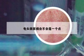 龟头银屑病会不会是一个点