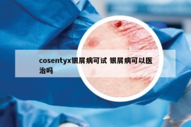 cosentyx银屑病可试 银屑病可以医治吗