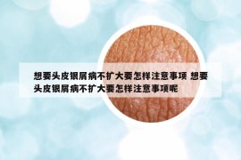 想要头皮银屑病不扩大要怎样注意事项 想要头皮银屑病不扩大要怎样注意事项呢