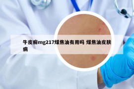 牛皮癣mg217煤焦油有用吗 煤焦油皮肤病