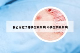 自己治愈了非典型银屑病 不典型的银屑病