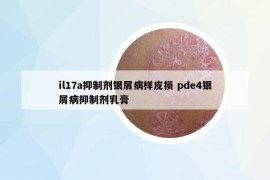 il17a抑制剂银屑病样皮损 pde4银屑病抑制剂乳膏