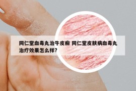 同仁堂血毒丸治牛皮癣 同仁堂皮肤病血毒丸治疗效果怎么样?