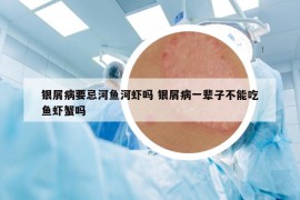 银屑病要忌河鱼河虾吗 银屑病一辈子不能吃鱼虾蟹吗