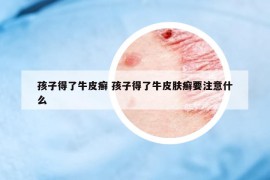 孩子得了牛皮癣 孩子得了牛皮肤癣要注意什么