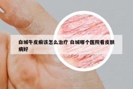 白城牛皮癣该怎么治疗 白城哪个医院看皮肤病好