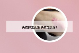 头皮鲜怎么治 头皮怎么治?