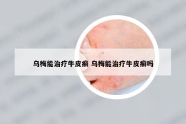 乌梅能治疗牛皮癣 乌梅能治疗牛皮癣吗