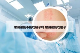 银屑病能不能吃橘子吗 银屑病能吃橙子