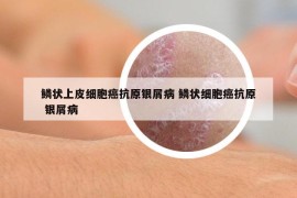 鳞状上皮细胞癌抗原银屑病 鳞状细胞癌抗原 银屑病
